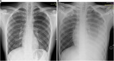 Intralobar Pulmonary Sequestration Presenting as Hemothorax Secondary to Spontaneous Pneumothorax: Case Report and Literature Review